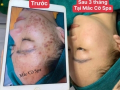 Mắc Cỡ Spa Điều Trị Mụn Và Gội Dưỡng Sinh